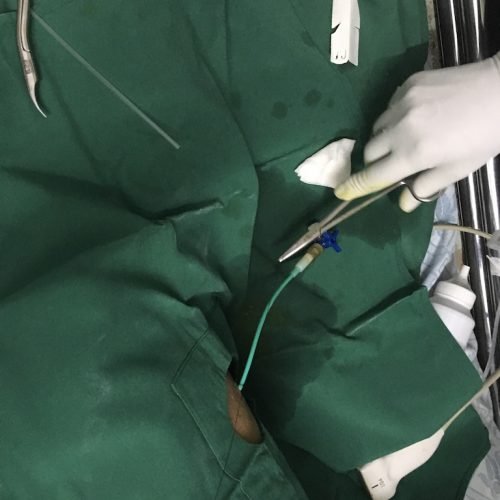 Liver abscess drainage - Liver Surgery