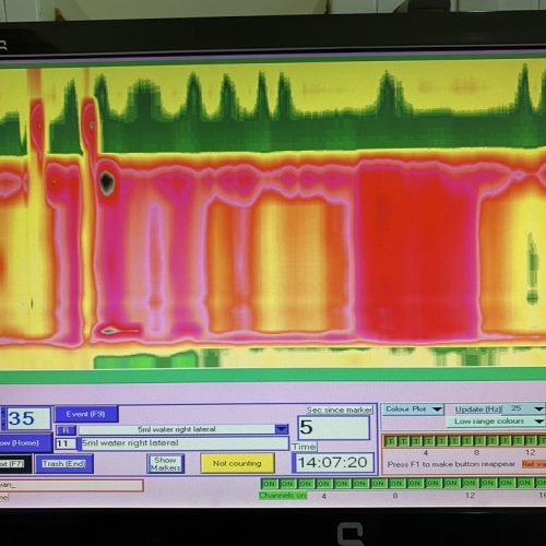 Manometry in children